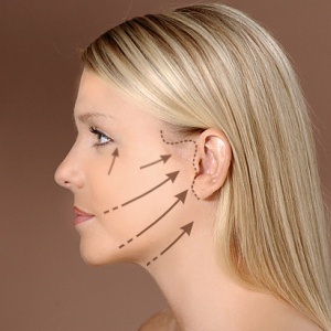 face-lift