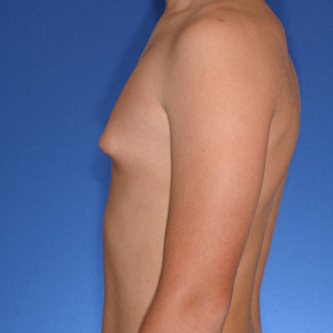 Gynaecomastia